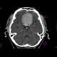 Meningioma of cribrous lamina: CT - Computed tomography
